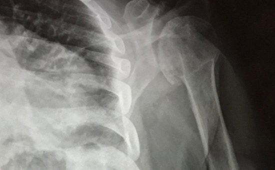 Complex Reverse Shoulder Replacement in a Crutch-dependent patient