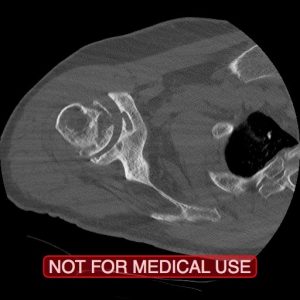 Complex Reverse Shoulder Replacement in a Crutch-dependent patient