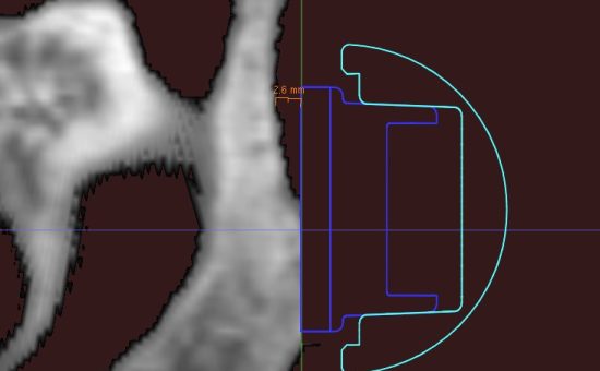 Complex Reverse Shoulder Replacement in a Crutch-dependent patient