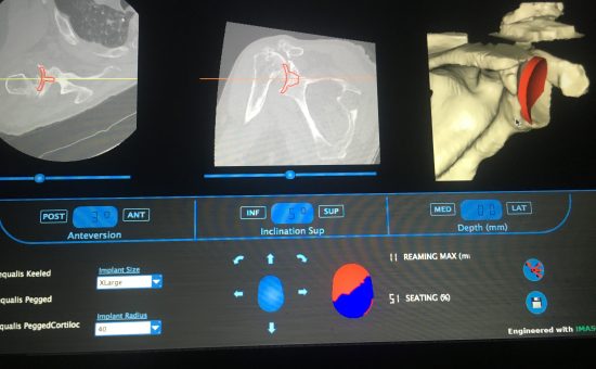 Complex Reverse Shoulder Replacement in a Crutch-dependent patient