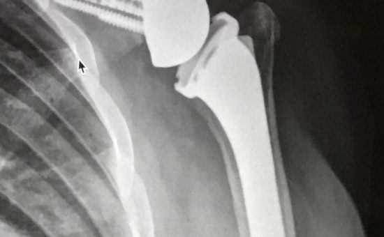 Complex Reverse Shoulder Replacement in a Crutch-dependent patient