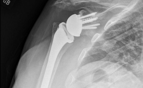 Complex Reverse Shoulder Replacement in a Crutch-dependent patient